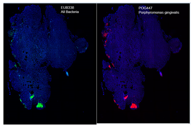  根尖周病變樣本微生物FISH檢測（綠色: 全細菌探針;紅色：牙齦卟啉單胞菌探針）